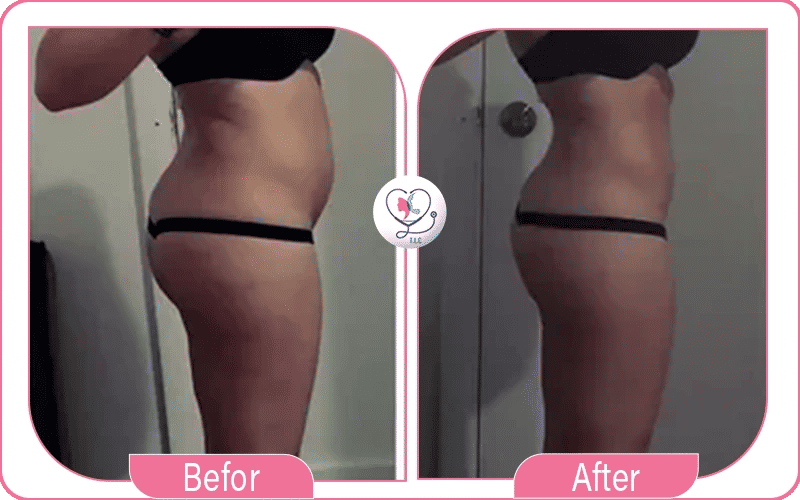 تجربتي مع عملية نحت الجسم بالليزر