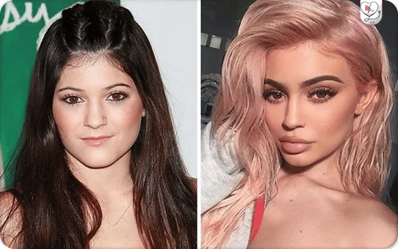 Kylie Jenner et les injections