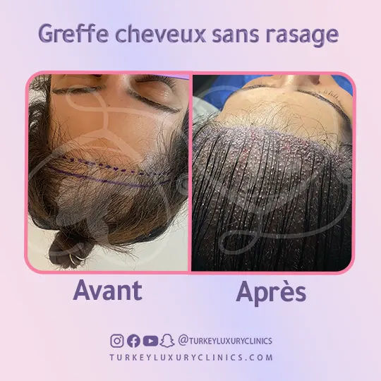 greffe cheveux pour femme sans rasage avant après