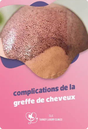 Les complications de la greffe de cheveux