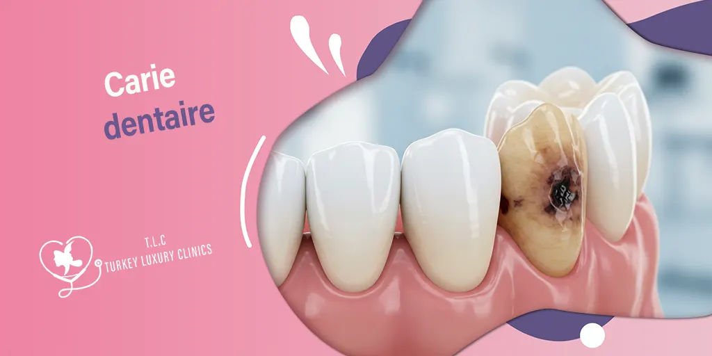 Carie dentaire : Causes, symptômes et traitements pour l'éliminer