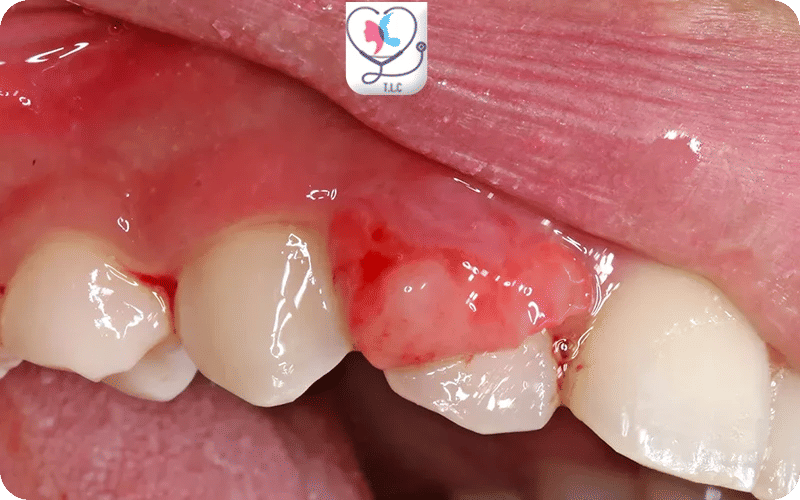 العلاج الجراحي لسرطان اللثة