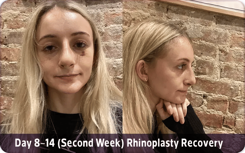 Day 8–14 (Second Week) Rhinoplasty Recovery with Photos