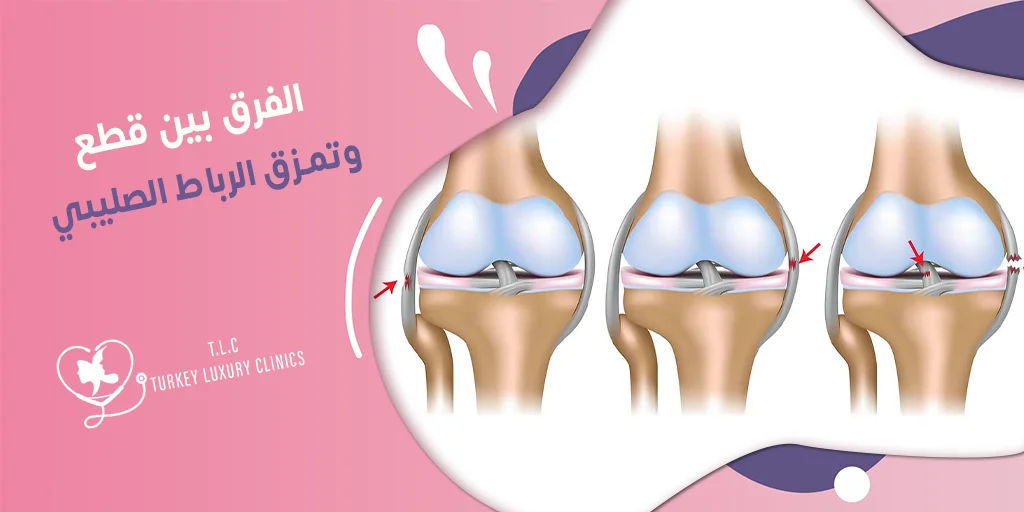 الفرق بين قطع وتمزق الرباط الصليبي: أهم العلامات والأعراض