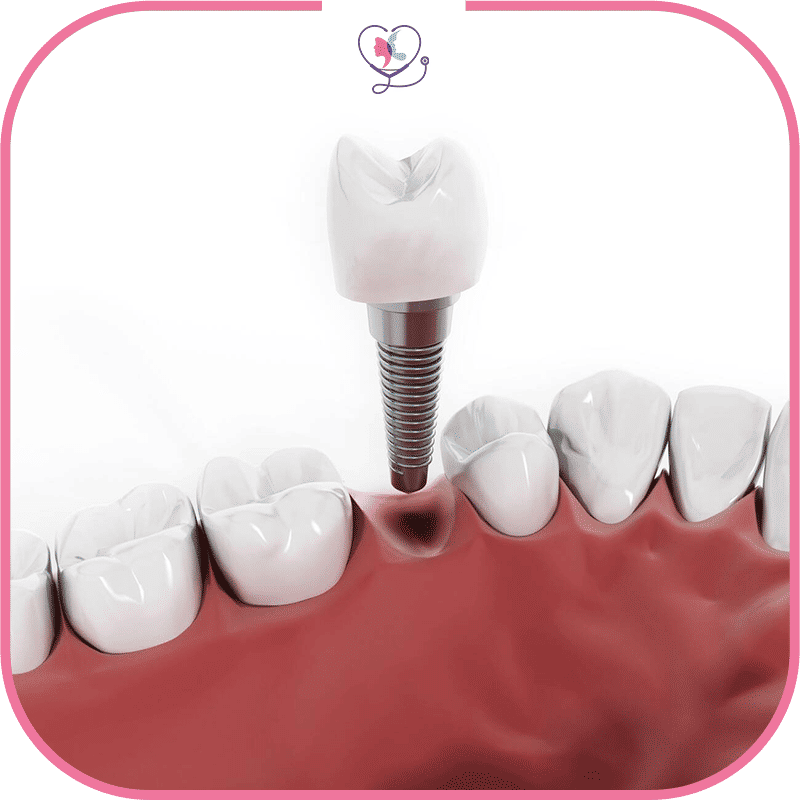 pose d'implant dentaire en zircone