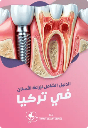 زراعة الأسنان في تركيا: الدليل الشاملfeatured image