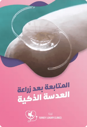 المتابعة بعد زراعة العدسة الذكية: متى يجب الاتصال بالطبيب؟featured image