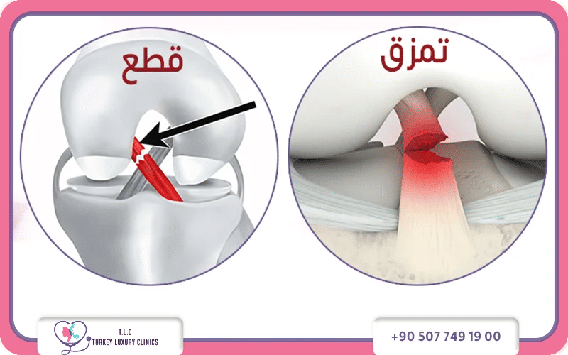 ما الفرق بين قطع وتمزق الرباط الصليبي من الناحية الطبية؟