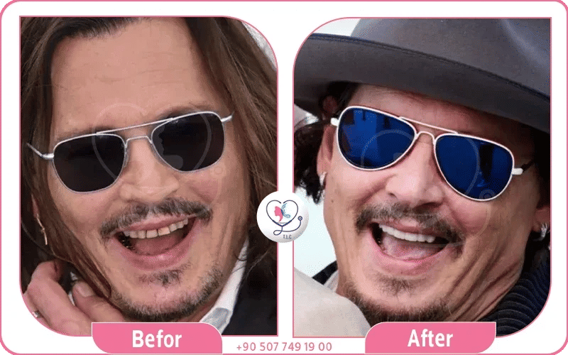 Get a Hollywood smile like Johnny Depp in Turkey – porcelain veneers and full smile design at Turkey Luxury Clinics Istanbul