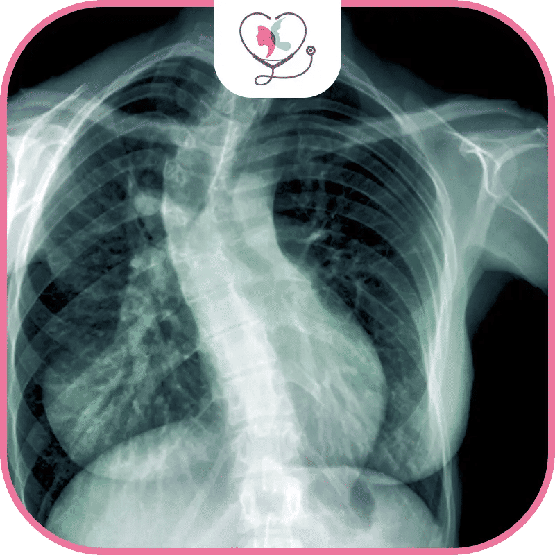 تكلفة جراحة الجنف في تركيا