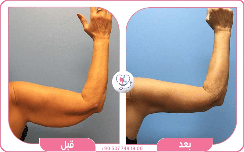 أنواع تقنيات شد الزنود