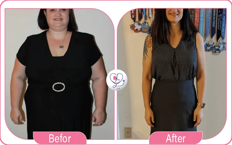 تجربتي مع التكميم وزني 80 كيلو