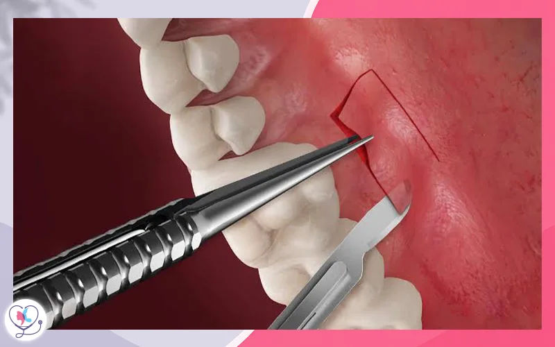تطعيم النسج الرخوة Soft tissue grafting