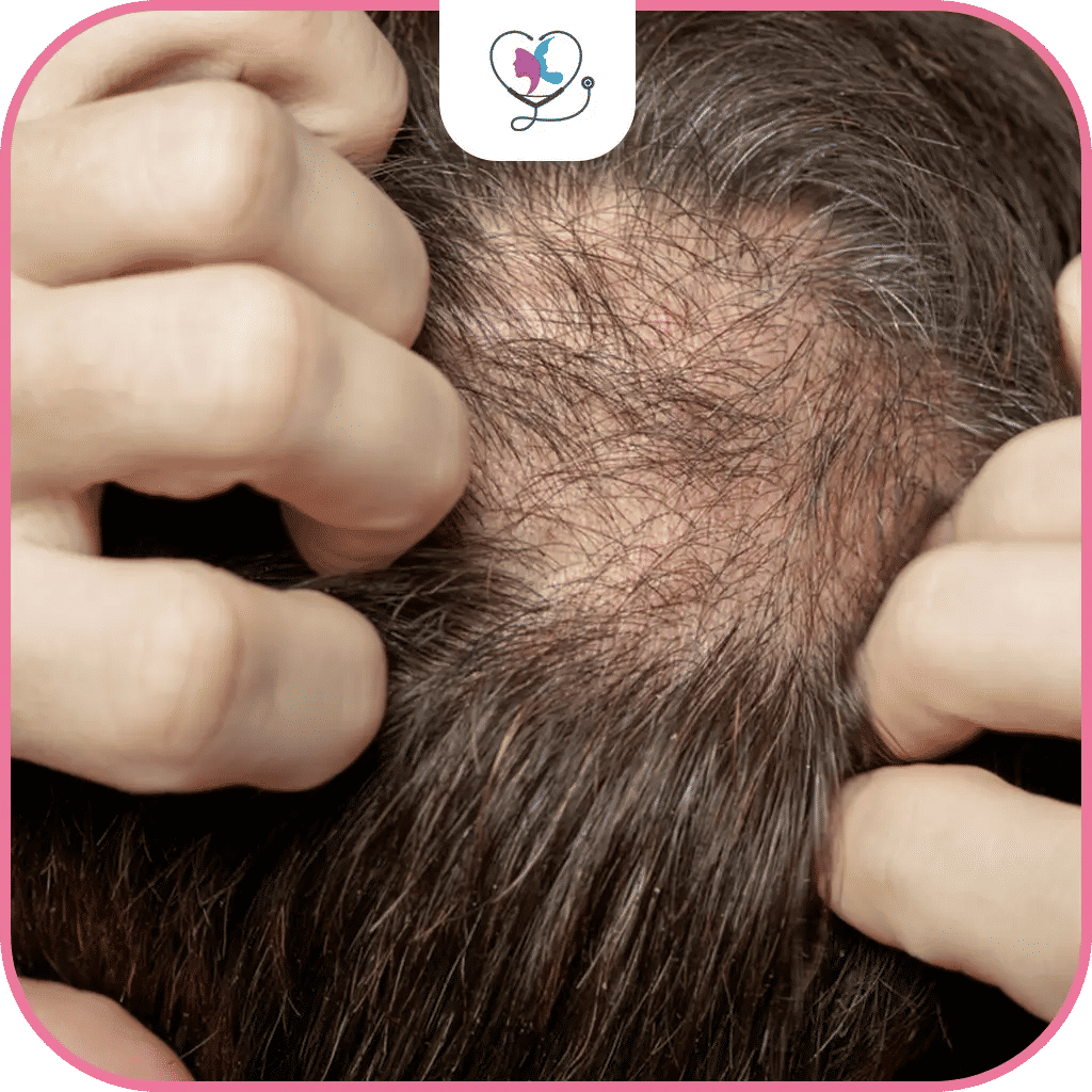 زراعة الشعر للرجال في تركيا