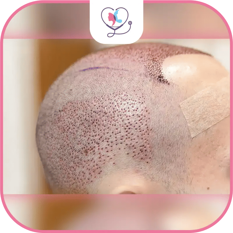 How to treat an infected hair transplant?