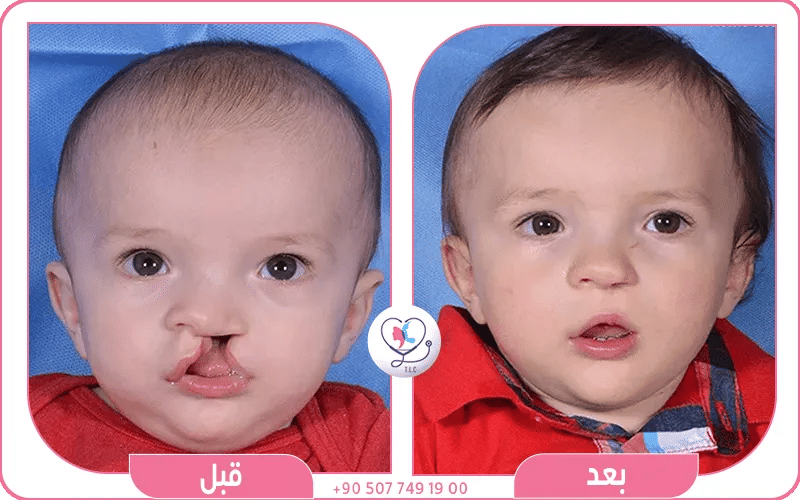الشفة الارنبية عند الاطفال
