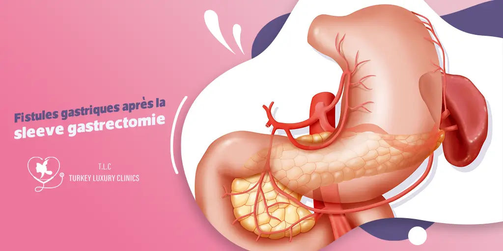 Fistules gastriques après la sleeve gastrectomie