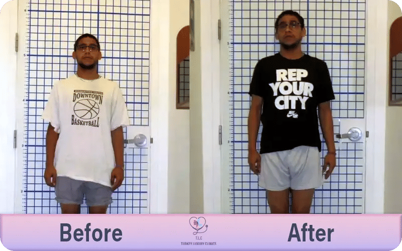 Height Increase Surgery Before and After Results