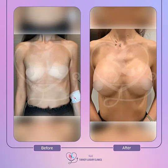 من هنّ المرشحات لإجراء عملية تكبير الثدي بالسليكون؟