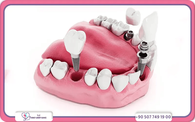 prix-des-implants-dentaires-en-turquie