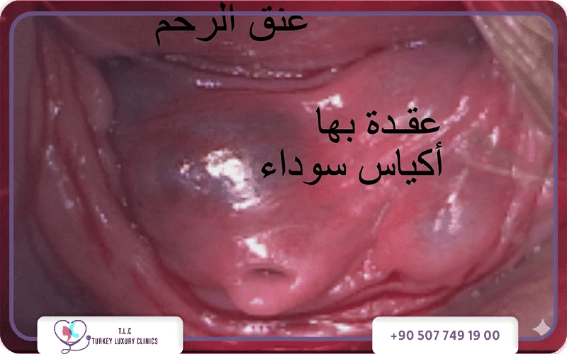 اعراض بطانة الرحم المهاجرة بحسب حالتك الاجتماعية