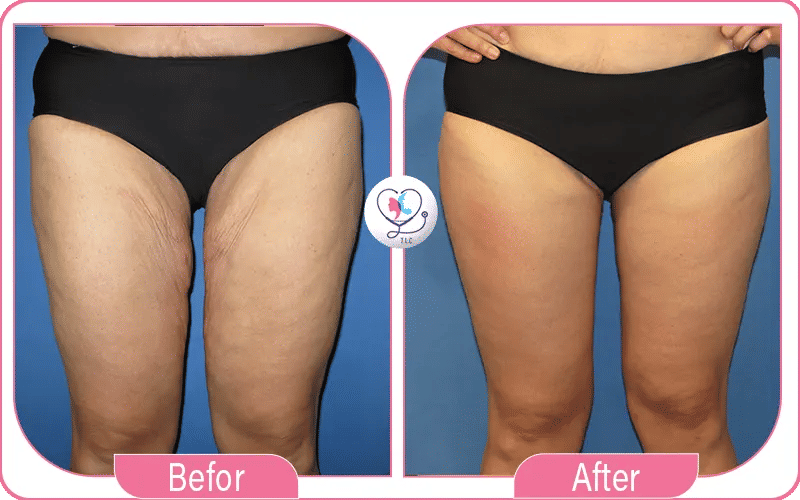 تجربتي في عملية شد ترهلات اللإفخاذ