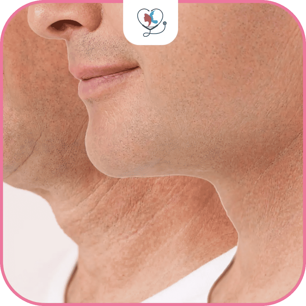 عملية شد الرقبة في تركيا