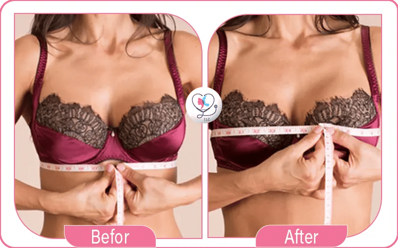 Quelle taille choisir pour votre augmentation mammaire ?