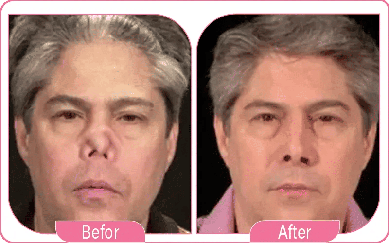 أعراض تشوه الأنف