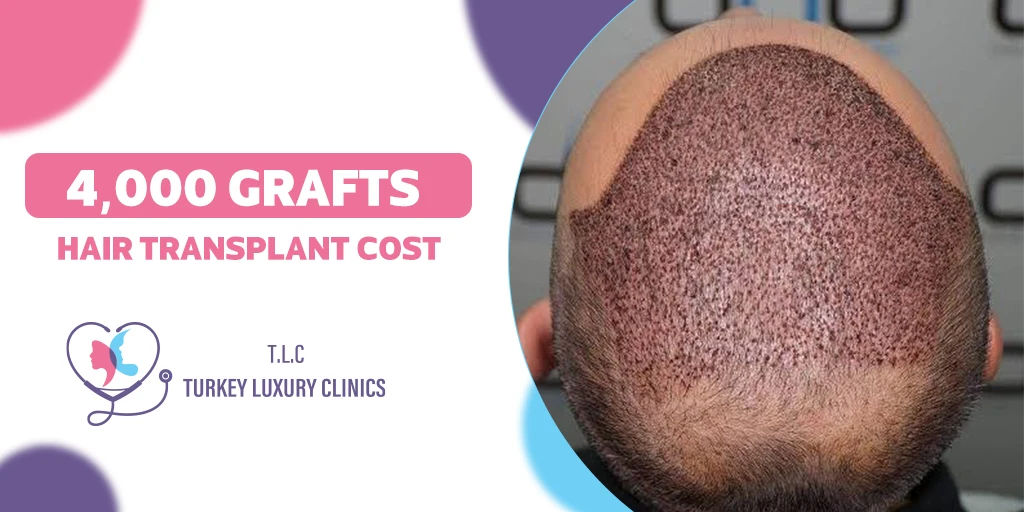 4,000 Grafts Hair Transplant Cost: 2026 Price, Coverage, Before & After