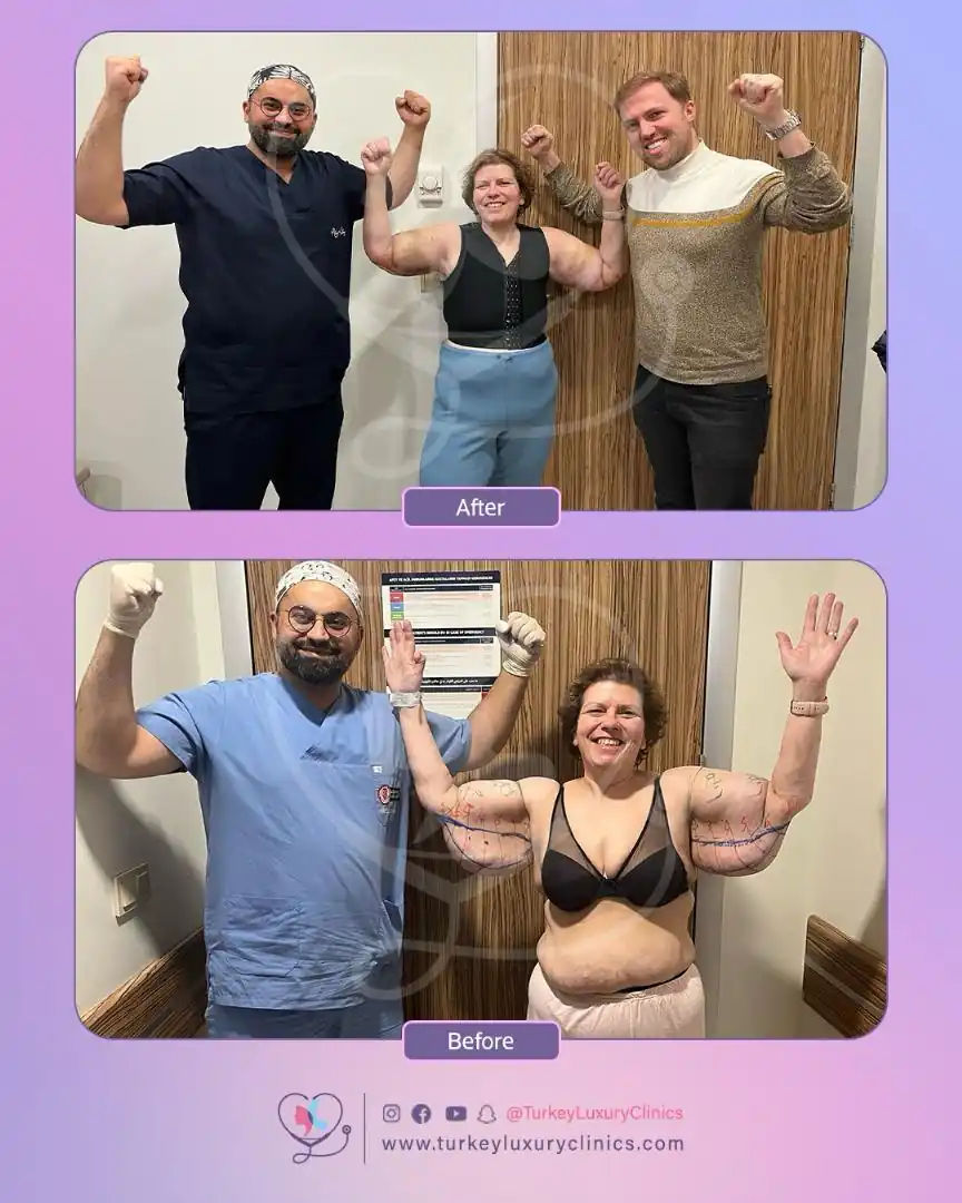 لماذا قررت الخضوع لعملية شد الذراعين؟