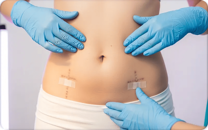 Side Effects,Risks and Complications Associated with Lipo 360