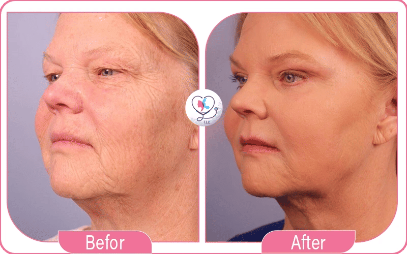 صور شد اللغلوغ بالخيوط قبل وبعد 1