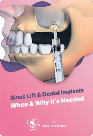 Sinus Lift and Dental Implants: When & Why It's Needed