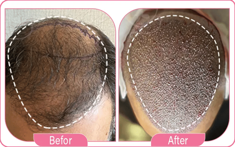 avis-et-témoignages-sur-la-greffe-de-cheveux-en-turquie-2