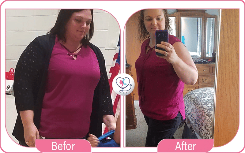 Chirurgie bariatrique avant / après