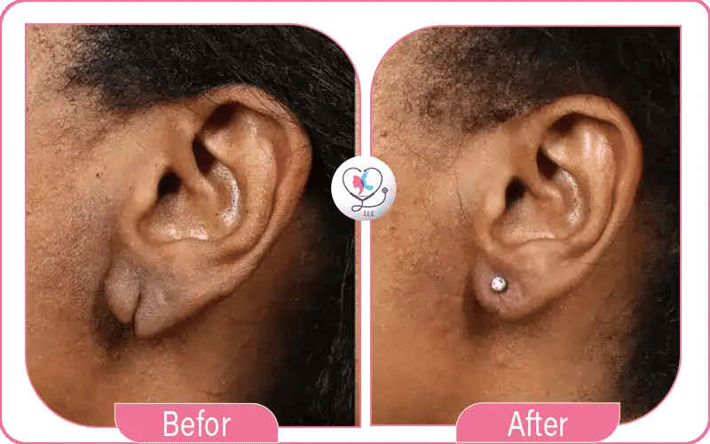Before and After Otoplasty