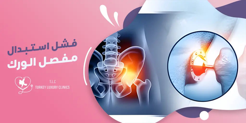 فشل استبدال مفصل الورك 