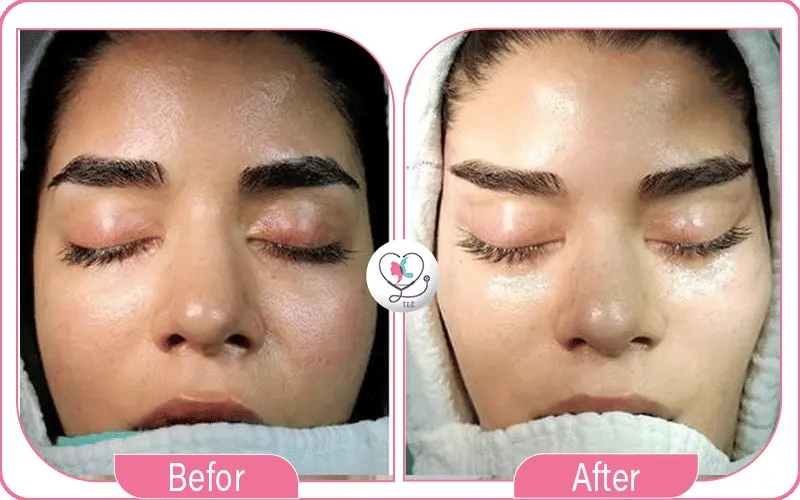 صور عملية عيون القطة قبل و بعد