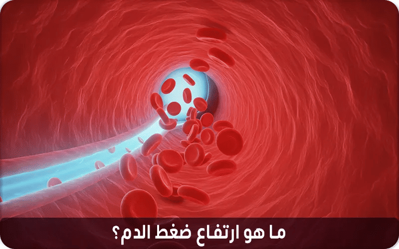 ما هو ارتفاع ضغط الدم؟