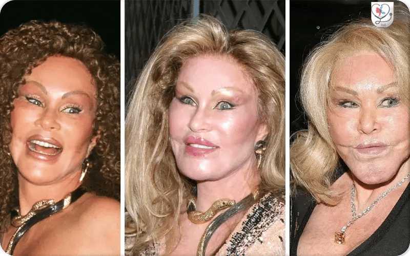 Chirurgie plastique ratée chez les stars