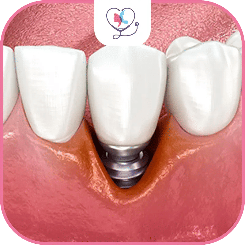 What is Dental Implant Infection?