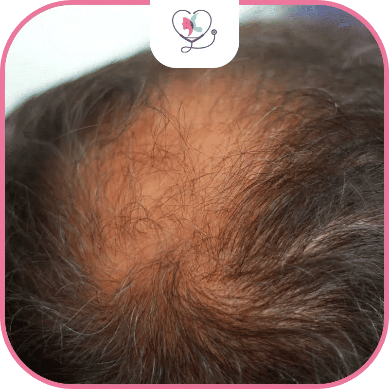 زراعة الشعر DHI في تركيا