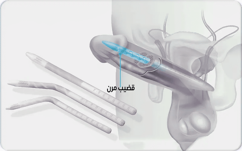 كيف تعمل الدعامة المرنة؟