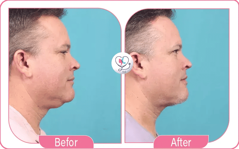 Before & After Results for Male Neck Lift 2