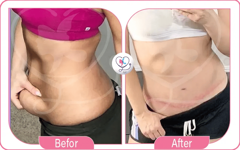 À quoi ressemble le résultat d’une liposuccion après 1 mois ?