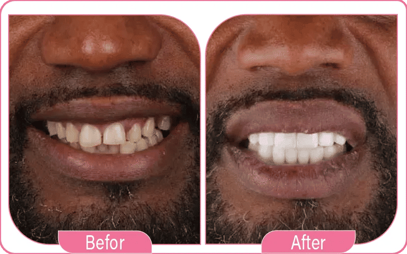 Emax Veneers in Turkey Before and After 2