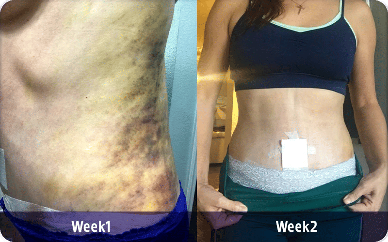 1 Week After Tummy Tuck