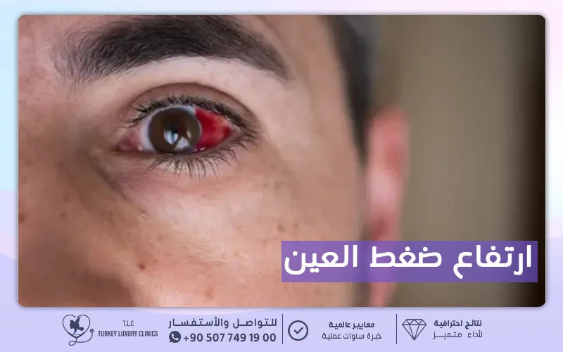 ارتفاع ضغط العين