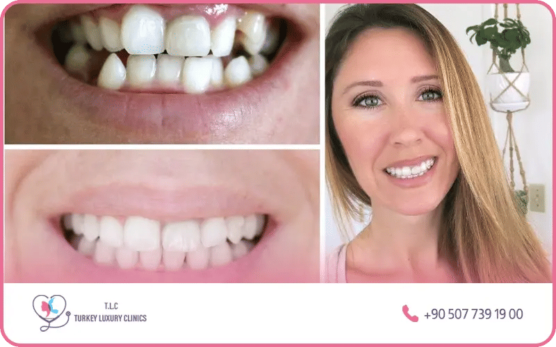 ransformation du sourire “Avant / Après” ransformation du sourire “Avant / Après”